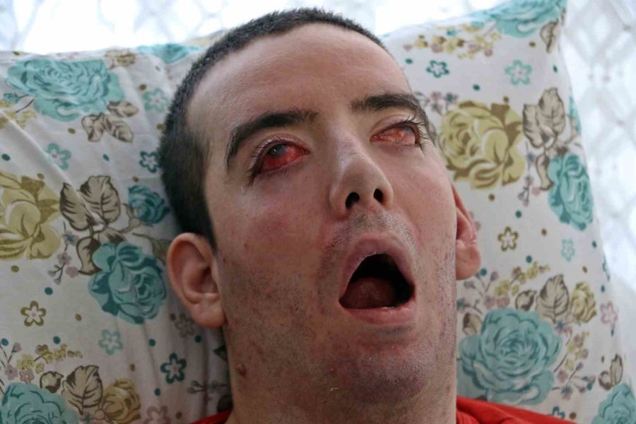 Görme Bozukluğuyla Başladı, 10 Yıldır Gözlerini Kapatamıyor