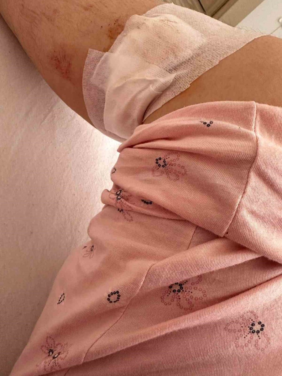 Konya’da Ziraat Mühendisi Kadın, Sokak Köpeğinin Saldırısında Yaralandı