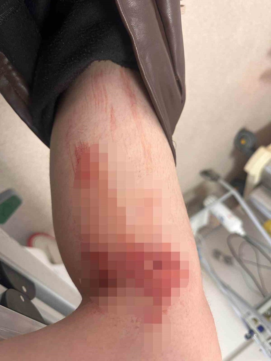 Konya’da Ziraat Mühendisi Kadın, Sokak Köpeğinin Saldırısında Yaralandı