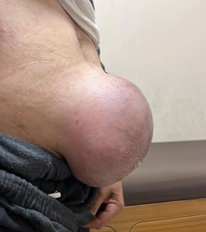 Top Büyüklüğünde Fıtığı Olan Hasta, Başarılı Operasyonla Sağlığına Kavuştu