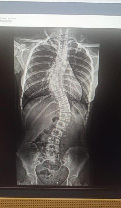 Skolyoz Hastası Zeynep Füzyon Cerrahisi İle Sağlığına Kavuştu