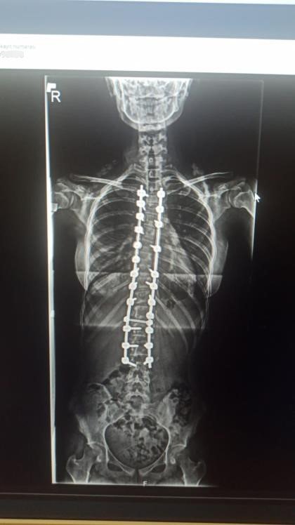 Skolyoz Hastası Zeynep Füzyon Cerrahisi İle Sağlığına Kavuştu