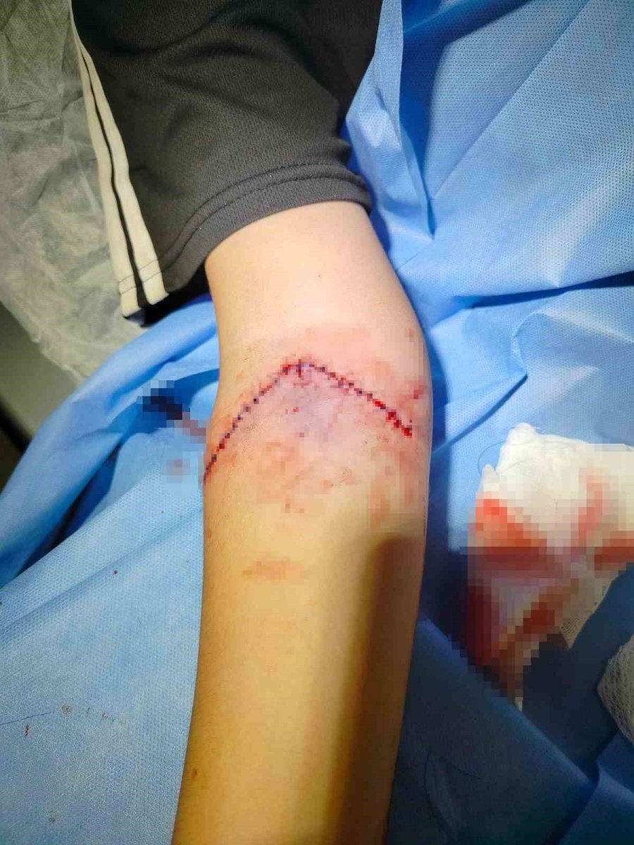 Basketbol Oynarken Kolu Tele Takılan Küçük Kız Kanlar İçinde Kaldı