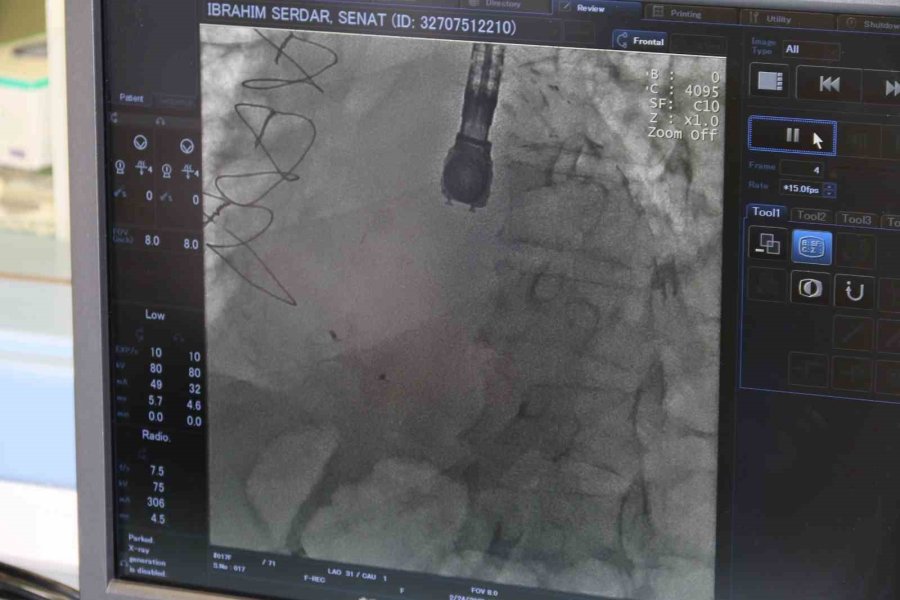 Kalbindeki Delik Kapatılan Hasta, Bu Rahatsızlığı Geçirip Yaşayan 9 Kişiden Biri Oldu