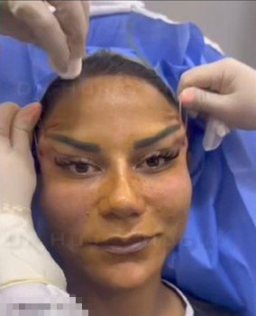 220 Bin Tl’ye Estetik Oldu, Hayatı Kabusa Döndü