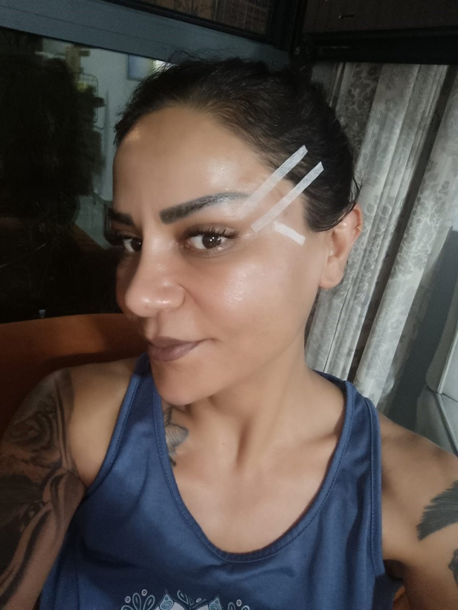 220 Bin Tl’ye Estetik Oldu, Hayatı Kabusa Döndü