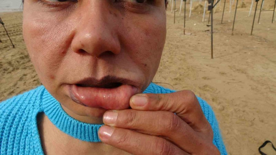 220 Bin Tl’ye Estetik Oldu, Hayatı Kabusa Döndü