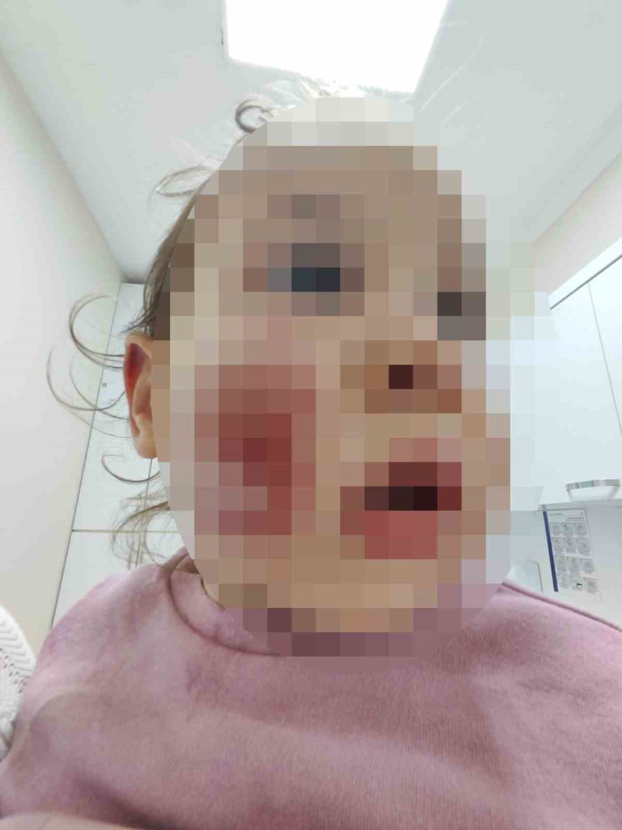 Aile Ve Sosyal Hizmetler Bakanlığından, Kreşte 2 Yaşındaki Çocuğun Darp Olayına İlişkin Açıklama