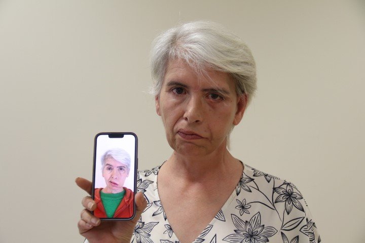 Sol Gözünü 30 Yıl Sonra 24 Ayar Altınla Yapılan Tedavi Sonucu Kapattı