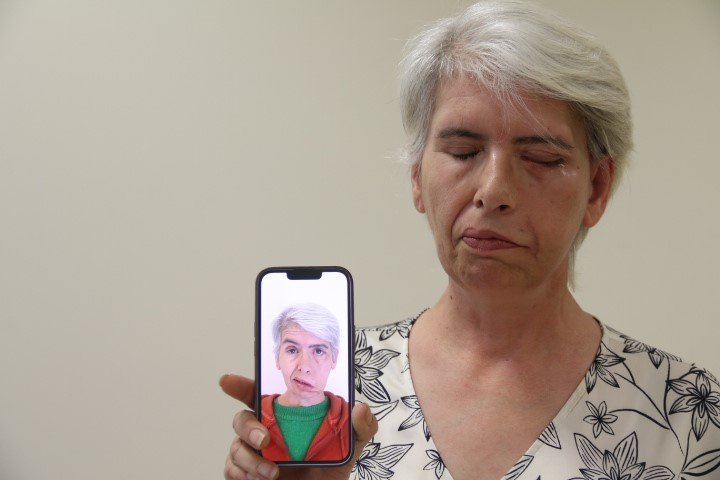 Sol Gözünü 30 Yıl Sonra 24 Ayar Altınla Yapılan Tedavi Sonucu Kapattı