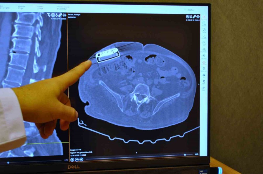 Gelişmiş Teknoloji Yeni Versiyon Baklofen Pompası Türkiye’de İlk Defa Eskişehir’de İmplante Edildi