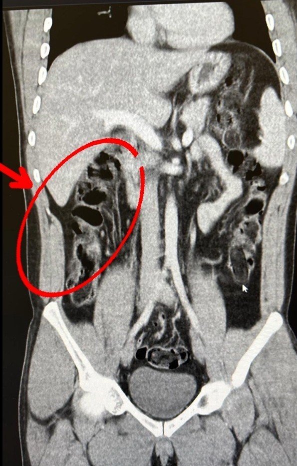 Uluslararası Uyuşturucu Ticaretine Büyük Darbe: Yuttukları Eroin Kapsülleriyle Havalimanında Yakalandılar
