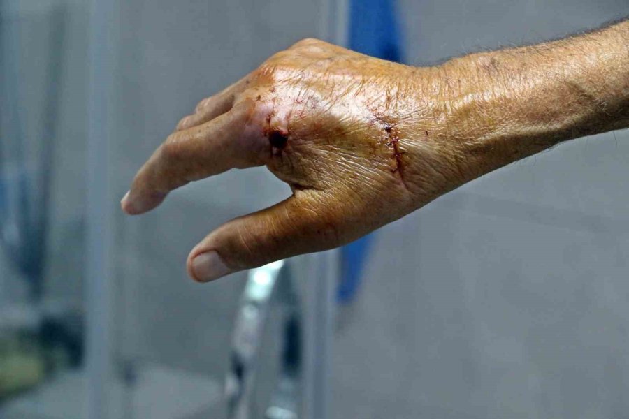 Patlayan Duş Kabininde Yaralandı, 1 Aydır Direksiyon Başına Geçemiyor