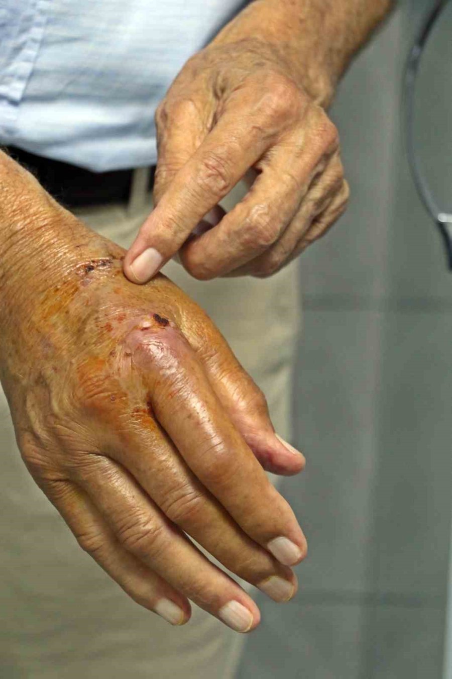 Patlayan Duş Kabininde Yaralandı, 1 Aydır Direksiyon Başına Geçemiyor