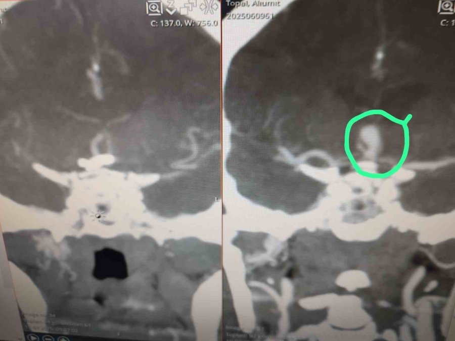 Anevrizma Ameliyatında Estetik Ve Konfor