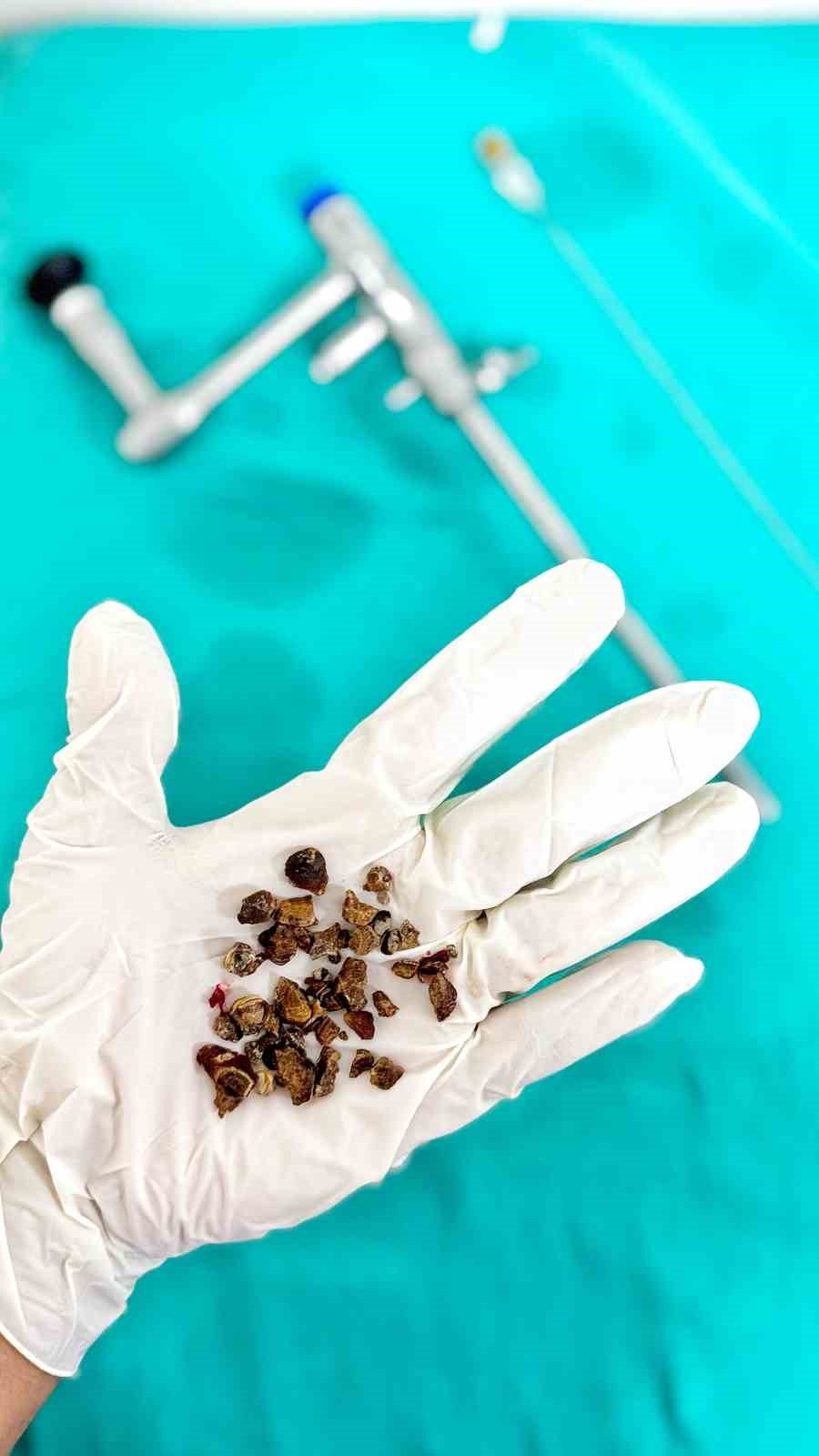 Gazipaşa‘da İki Başarılı Ameliyatla Hasta Böbrek Taşlarından Kurtuldu