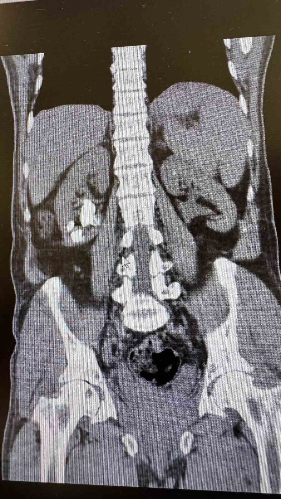 Gazipaşa‘da İki Başarılı Ameliyatla Hasta Böbrek Taşlarından Kurtuldu