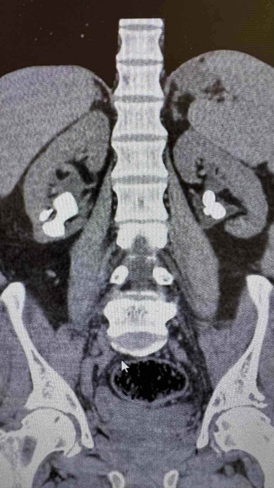 Gazipaşa‘da İki Başarılı Ameliyatla Hasta Böbrek Taşlarından Kurtuldu
