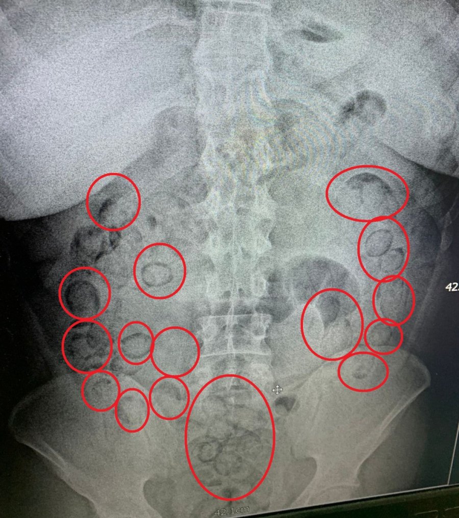 İranlı Tacir, Yutup Midesine Sakladığı 433 Gram Uyuşturucuyla Yakalandı