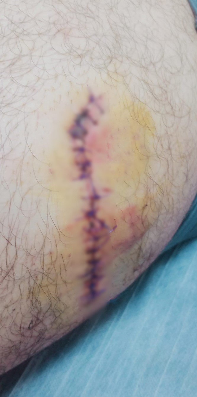 Okulda Başlayan Kavga Okul Dışına Taştı, Liseli Çocuk Bıçaklandı