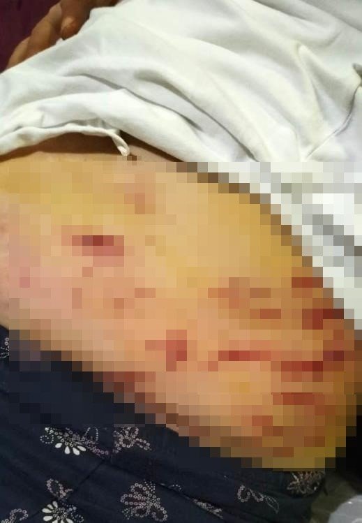 Mersin’deki Köpek Dehşeti: Köpeğin Isırdığı Anne Yaşananları Anlattı