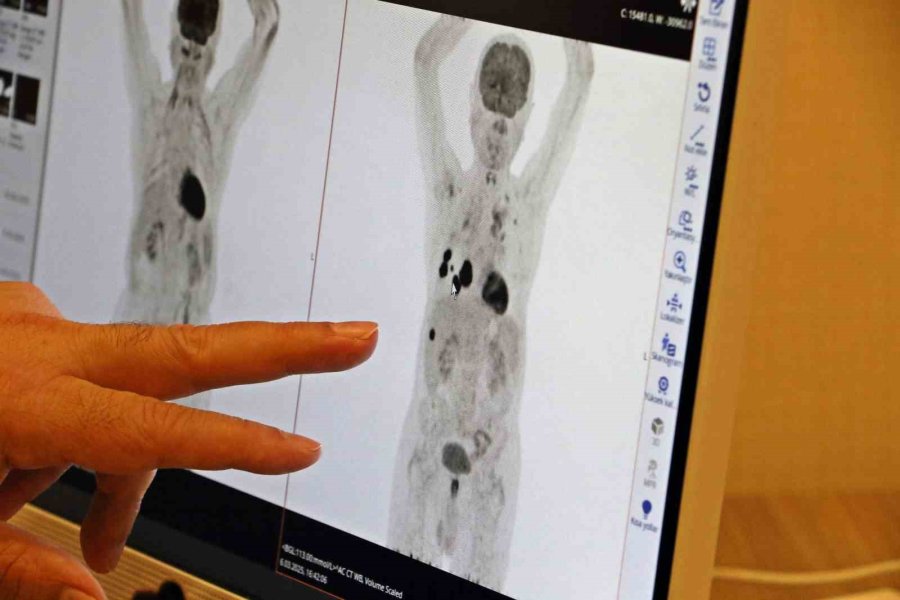 Prof. Dr. Ali Murat Tatlı: "akciğer Kanseri Tedavisinde Sağ Kalım Oranları Artıyor"