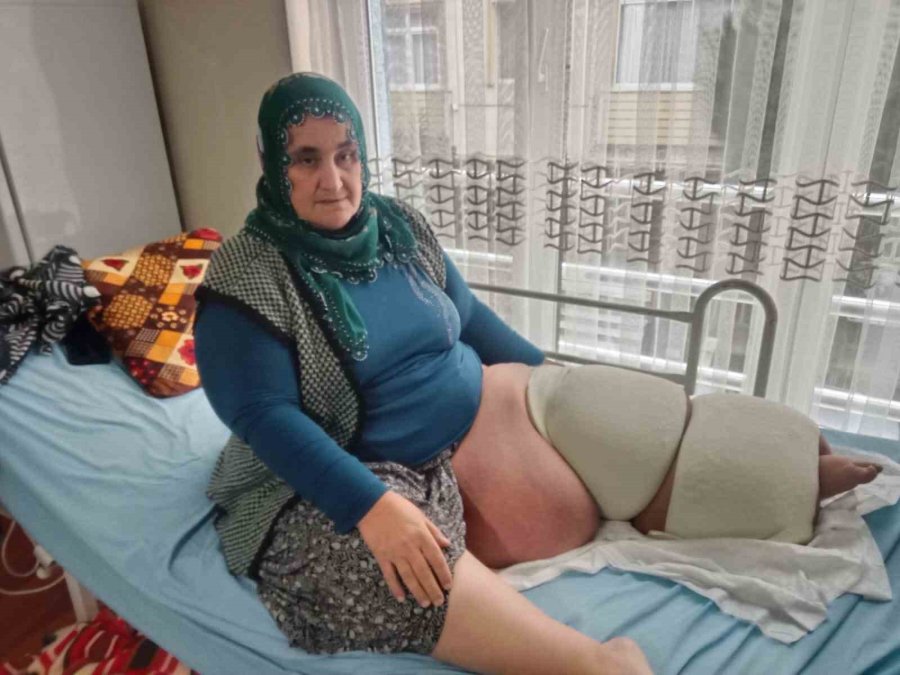 Fil Hastalığı Bacağını 100 Kilo Yaptı, Tedavisinin Devamı İçin Destek Bekliyor