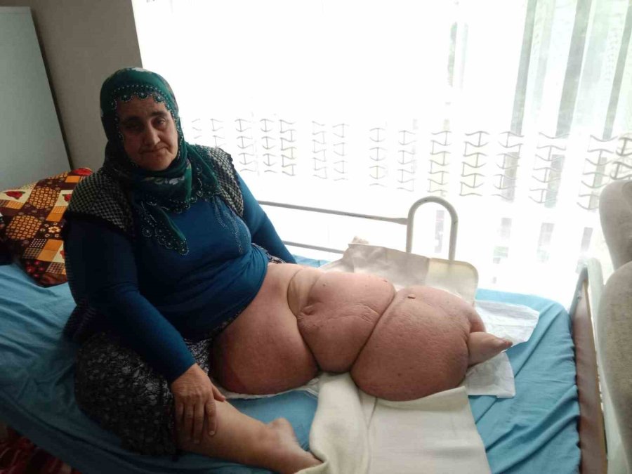 Fil Hastalığı Bacağını 100 Kilo Yaptı, Tedavisinin Devamı İçin Destek Bekliyor