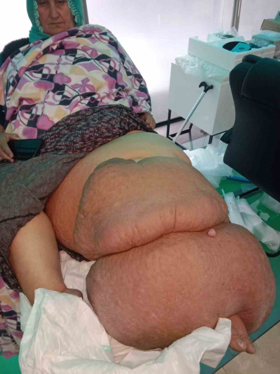 Fil Hastalığı Bacağını 100 Kilo Yaptı, Tedavisinin Devamı İçin Destek Bekliyor