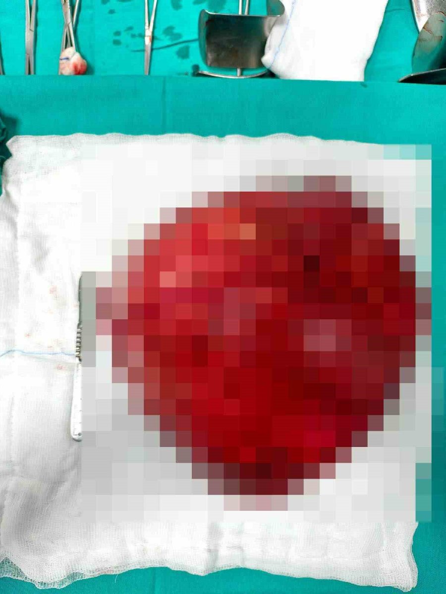 Karın Boşluğundan 40 Santimetre Büyüklüğünde Kitle Çıkarıldı