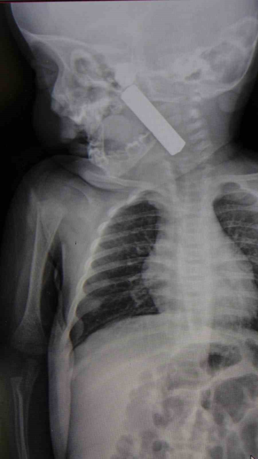 Karaman’da Boğazına Kumanda Pili Kaçan Bebek Ölümden Döndü