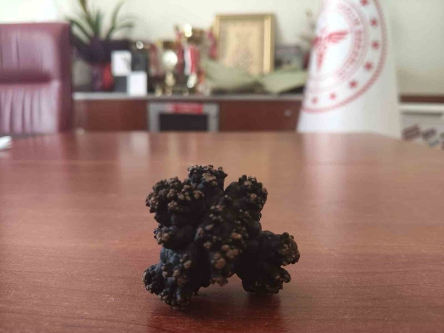 Bozyazı’da 4 Santimetrelik Mesane Taşı Tek Parça Halinde Çıkarıldı.