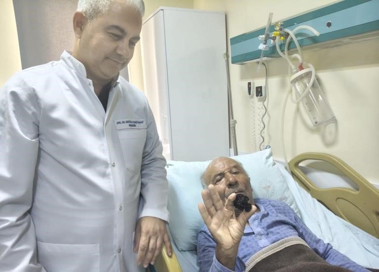 Bozyazı’da 4 Santimetrelik Mesane Taşı Tek Parça Halinde Çıkarıldı.
