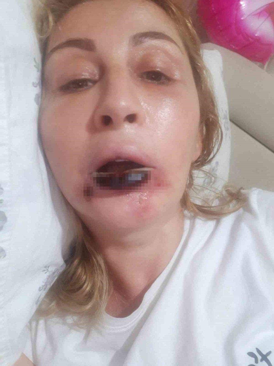 Estetik İşlem Sonrası Dudağı Çürüdü, 7 Yıldır Hukuk Mücadelesi Veriyor