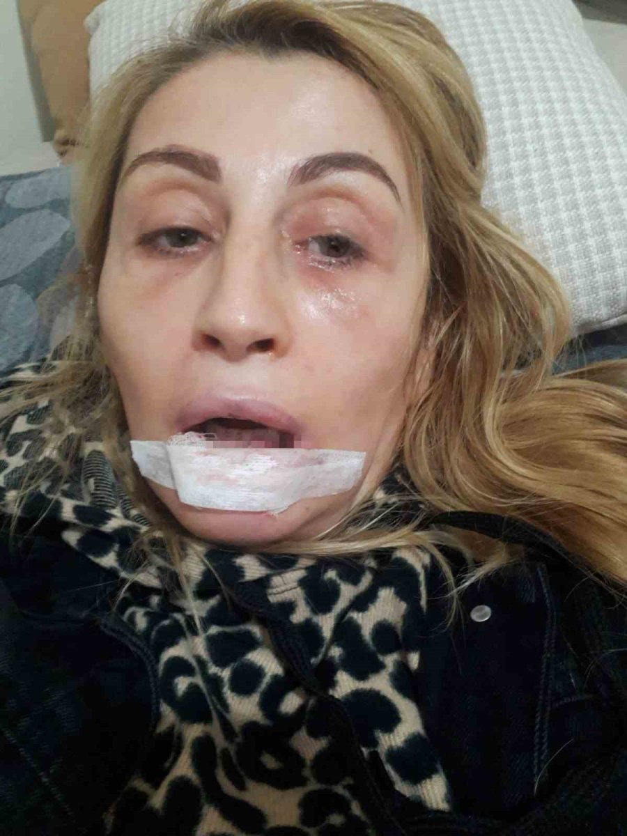 Estetik İşlem Sonrası Dudağı Çürüdü, 7 Yıldır Hukuk Mücadelesi Veriyor