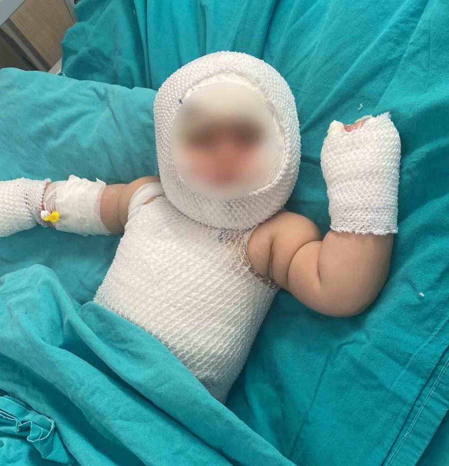 Mersin’de Patlayan Domates Konservesi 9 Aylık Bebeği Yaktı